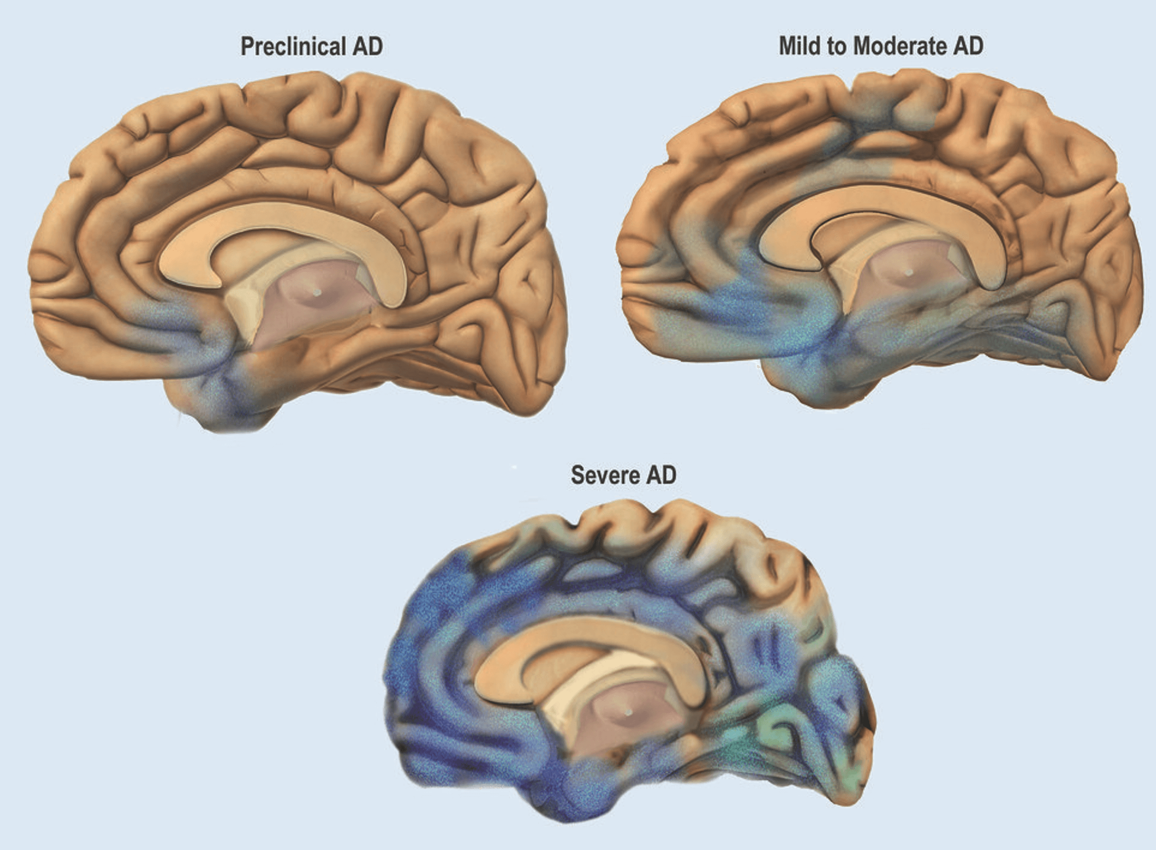 /projects/s2_alzheimer_classification_challenge/images/s2_alzheimer_classification_challenge_1.png