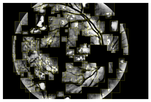 /projects/s2_soft_exudates_detection_in_fundus_images/images/s2_soft_exudates_detection_in_fundus_images_1.png