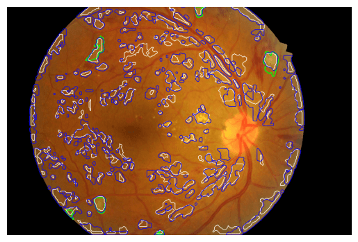 /projects/s2_soft_exudates_detection_in_fundus_images/images/s2_soft_exudates_detection_in_fundus_images_3.png