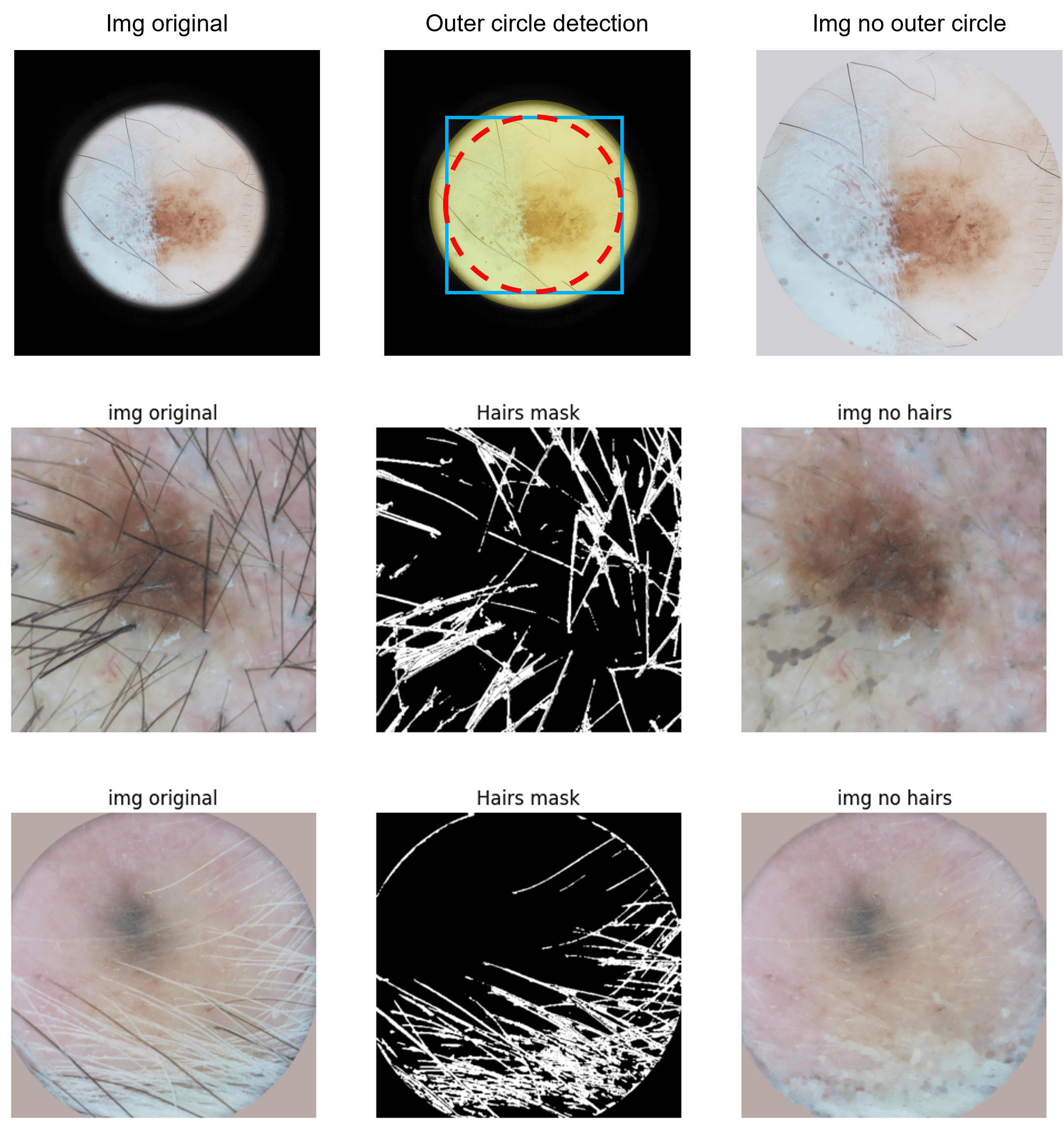 /projects/s3_skin_lesion_detection_ml/images/s3_skin_lesion_detection_ml_3.png