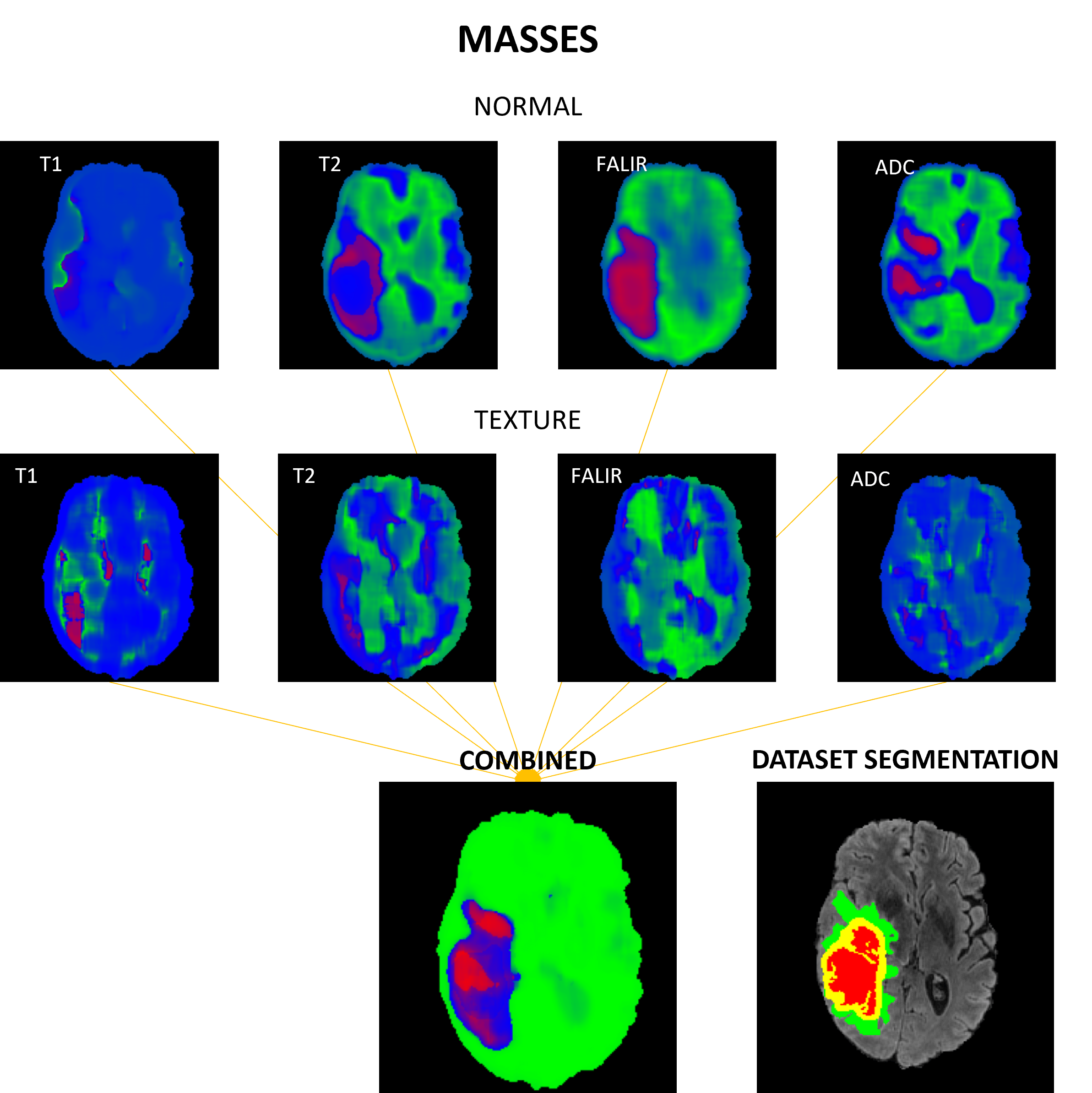 /projects/ub_brain_tumor_detection/images/ub_brain_tumor_detection_4.png